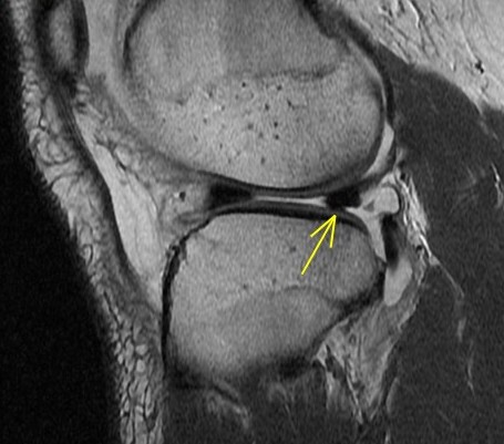 Figure 4 for case Unstable lateral meniscus flap tear